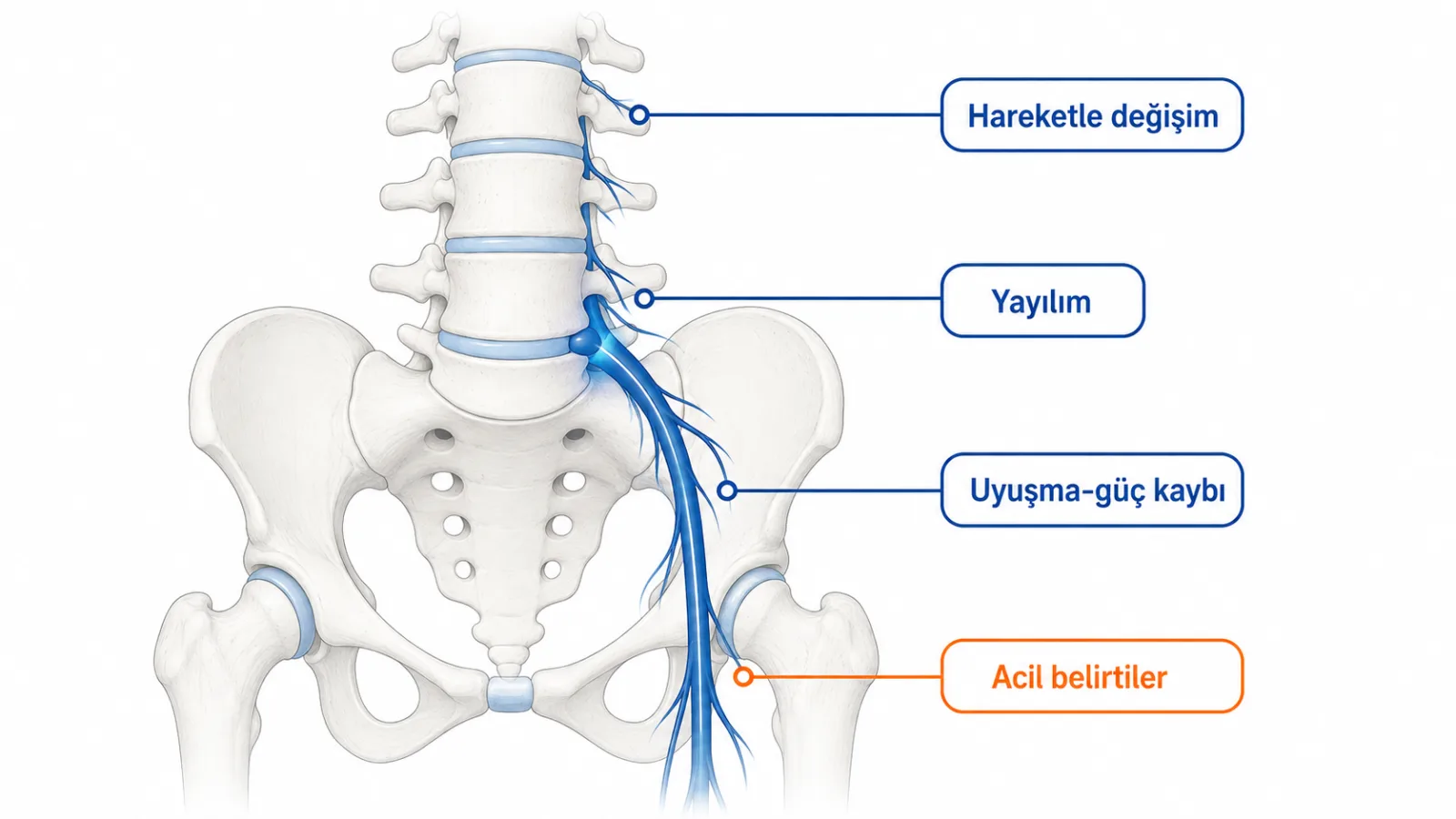 Bel ağrısında faset, disk-sinir, sakroiliak eklem ve dar kanal örüntülerini karşılaştıran şematik illüstrasyon