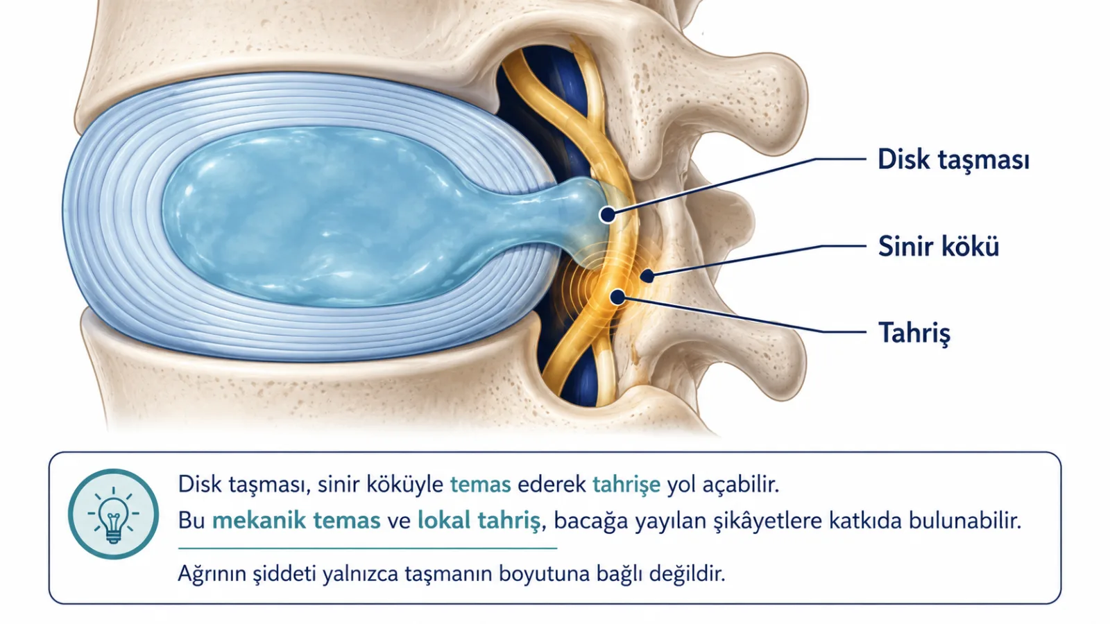 Bel diskinde dış halka ve iç bölümün taşmasını, sinir kökü çevresindeki tahrişi gösteren şematik anatomik illüstrasyon; gerçek radyoloji görüntüsü değildir.