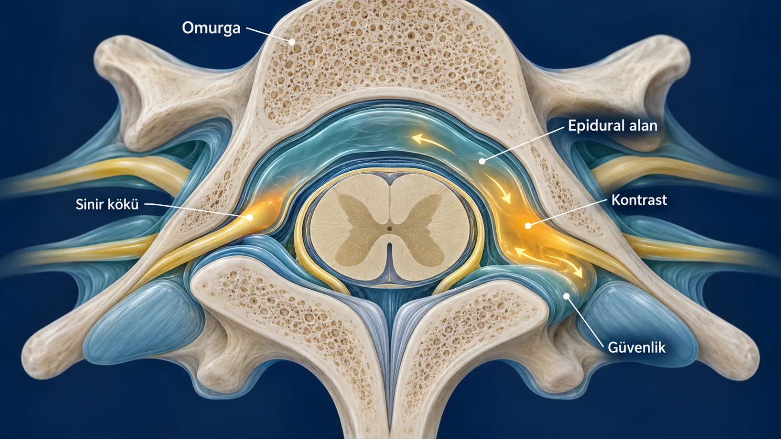 Epidural Enjeksiyon ve Ağrı (Aneljezik) Etkinliği için mechanism rolünde sade hasta bilgilendirme şeması; gerçek görüntü değildir.