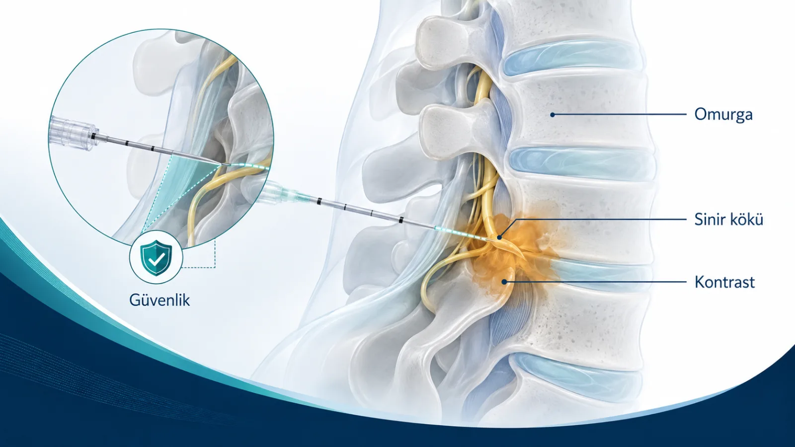 Selektif Sinir Kökü Blokajı için treatment_mechanism rolünde sade hasta bilgilendirme şeması; gerçek görüntü değildir.