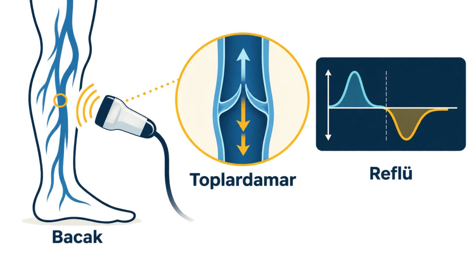Endovenöz Lazer ve RF Ablasyon ile Varis Tedavisi için diagnosis_imaging rolünde sade hasta bilgilendirme şeması; gerçek görüntü değildir.