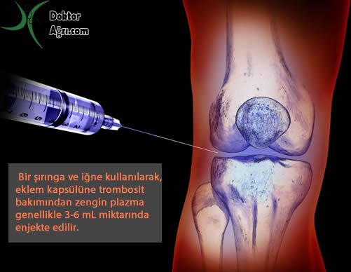diz enjeksiyon