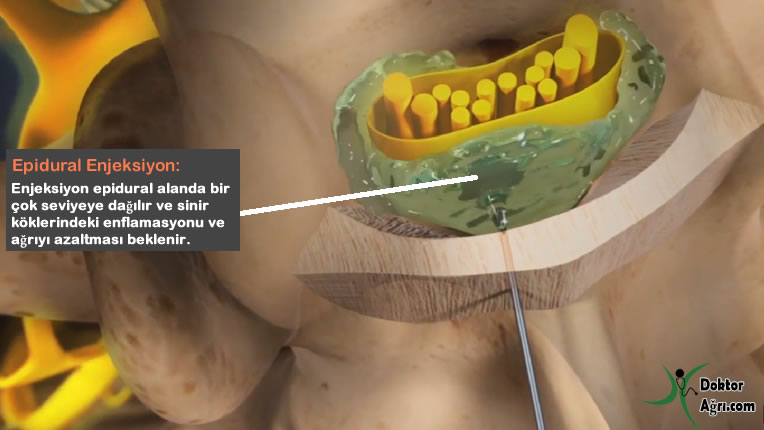 Epidural enjeksiyon ağrı tedavisi