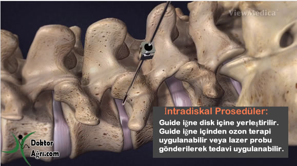 intradiskal ozon lazer bel fıtığı