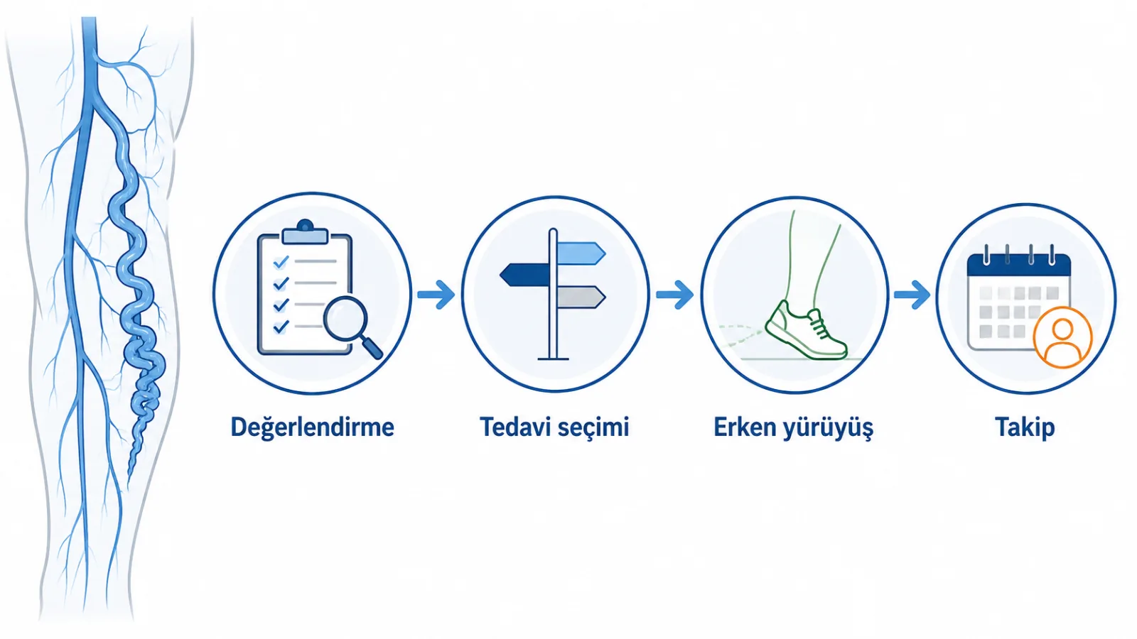 Varis ve bacak ağrısında değerlendirme, tedavi seçimi, erken yürüyüş ve takibi gösteren şematik tıbbi illüstrasyon; sonuç vaadi içermez.