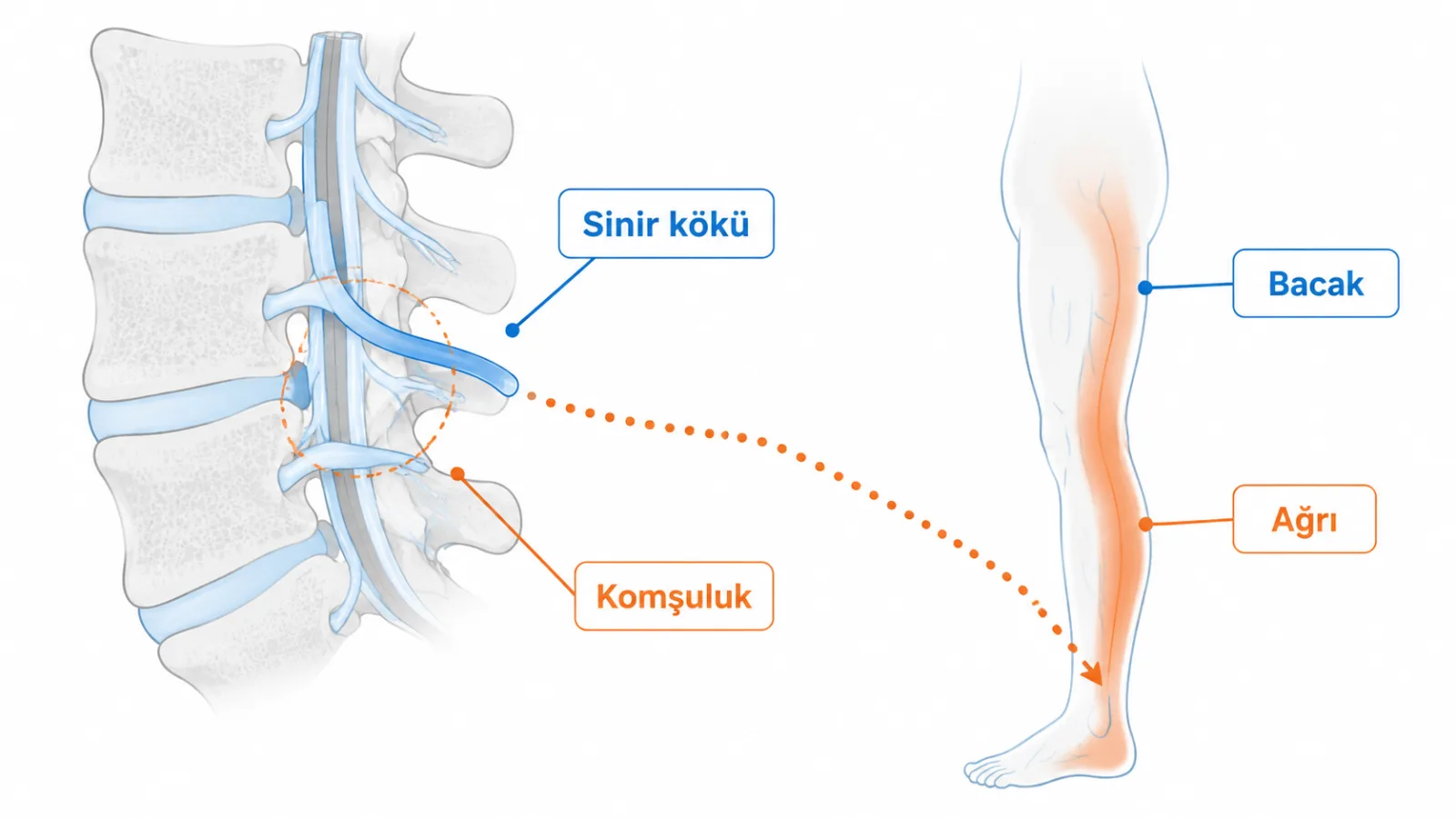 Disk ve kemik çevresindeki sinir kökü komşuluğunun bacağa yayılan belirtilerle olası ilişkisini anlatan sade mekanizma şeması; gerçek MR değildir.