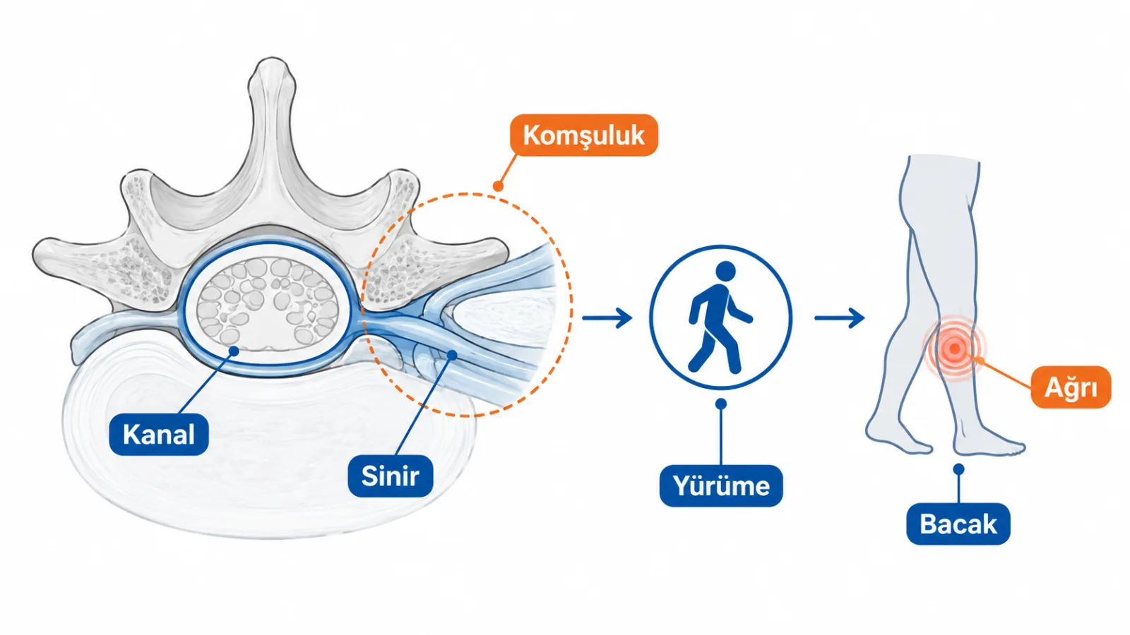Omurga kanalındaki daralmanın sinir kökleriyle komşuluğunu ve yürüme ile ilişkili olası belirti yolunu anlatan sade mekanizma şeması; gerçek MR değildir.